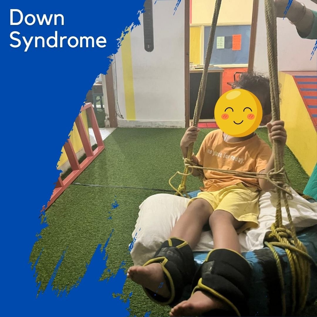 down syndrome 